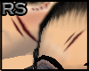 Scars